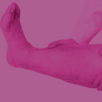 Острый тромбоз глубоких вен нижних конечностей: лечение