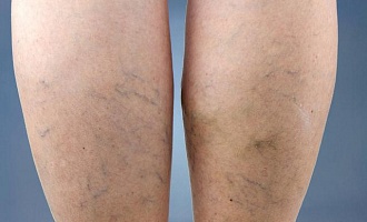 Варикоз на ногах у женщин, фото