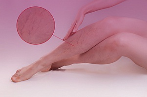 Усиленный сосудистый рисунок на ногах: причины появления и способы устранения